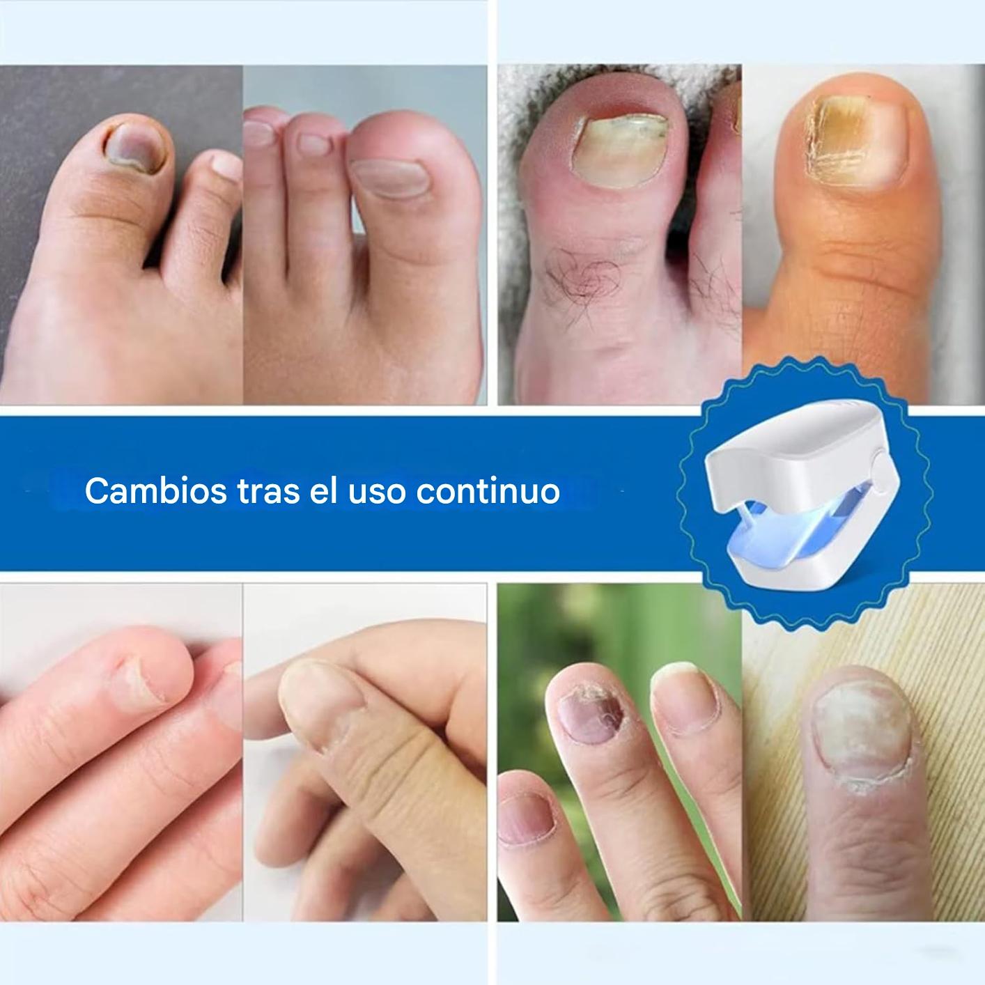 Clip de tratamiento Laser de hongos en las uñas