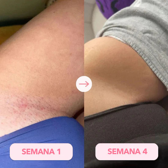 DEPILADORA LÁSER IPL PERMANENTE (Kit Completo)