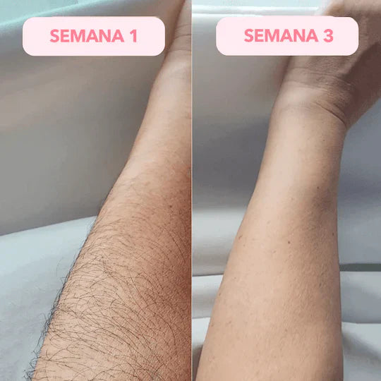 DEPILADORA LÁSER IPL PERMANENTE (Kit Completo)