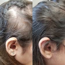 Block-DHT®: Cabello nuevo y autoestima renovada.